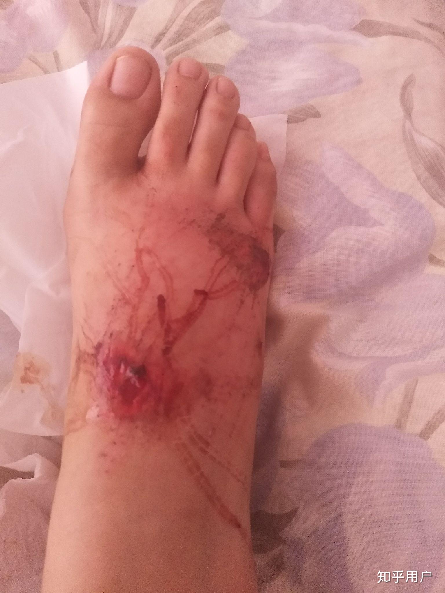 你们觉得伤口清创和缝合疼吗? - 知乎