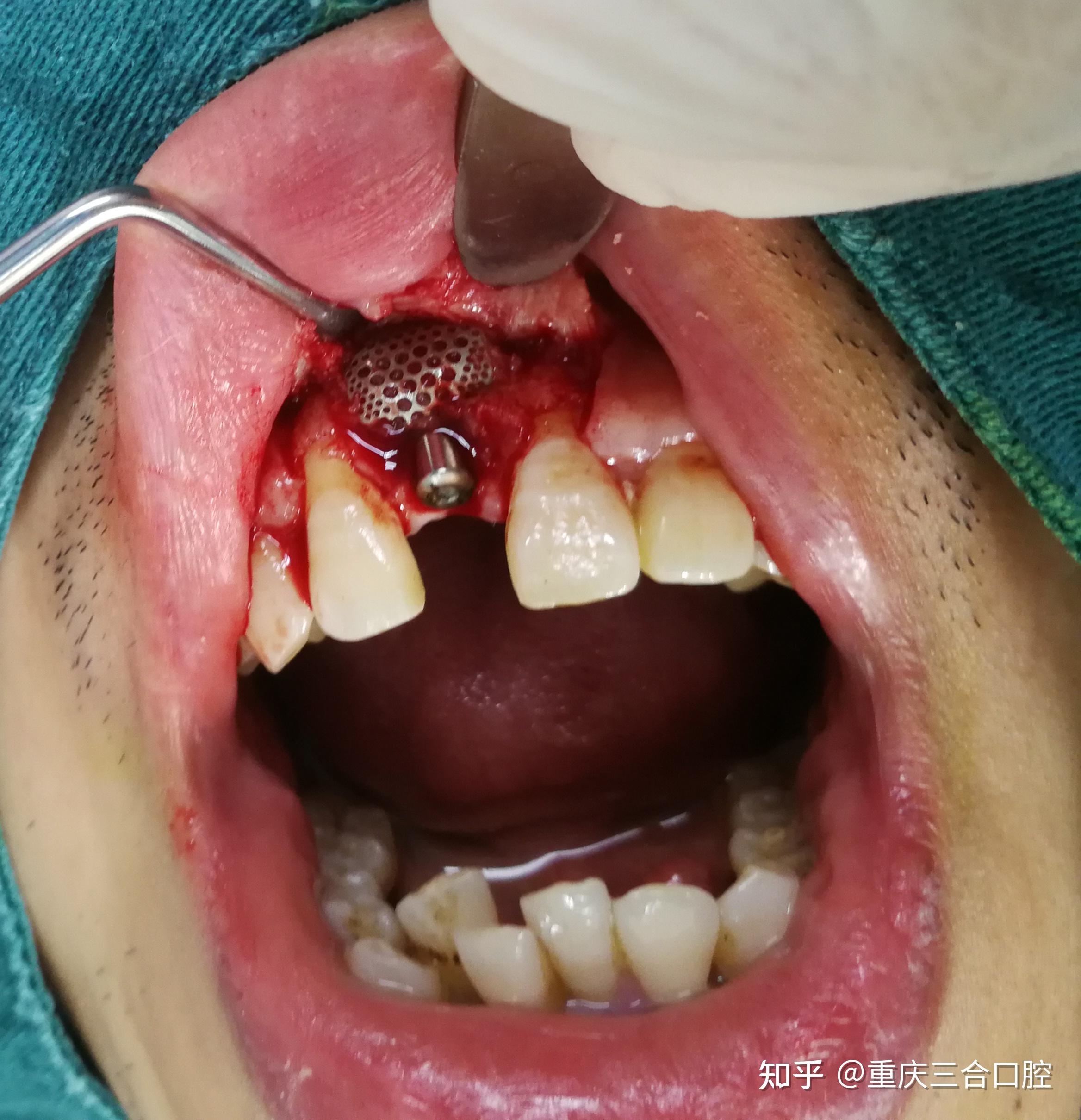 种植牙为什么要植骨? - 知乎