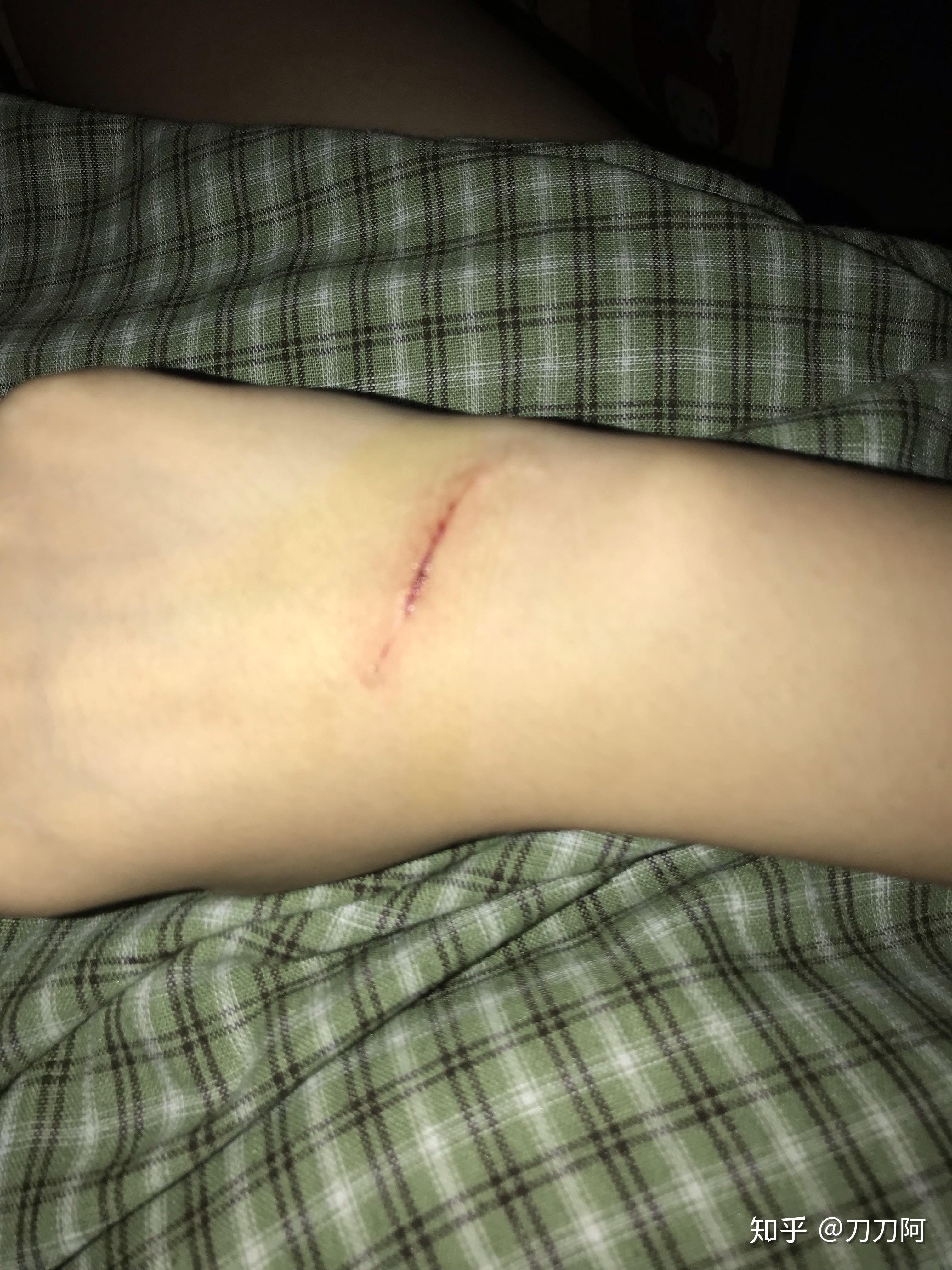 小伤口打破伤风是否小题大作