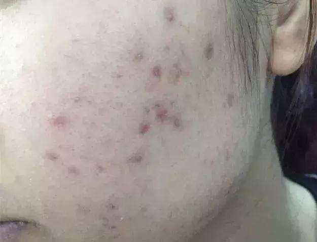 脸上有痘痘、痘印就不要这样做啦~ - 知乎