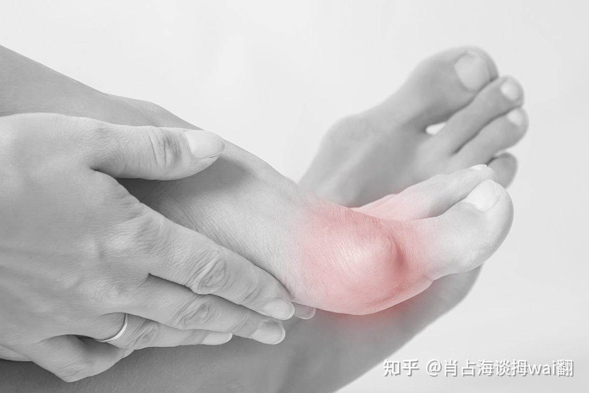 拇外翻往往会导致拇囊炎 - 知乎