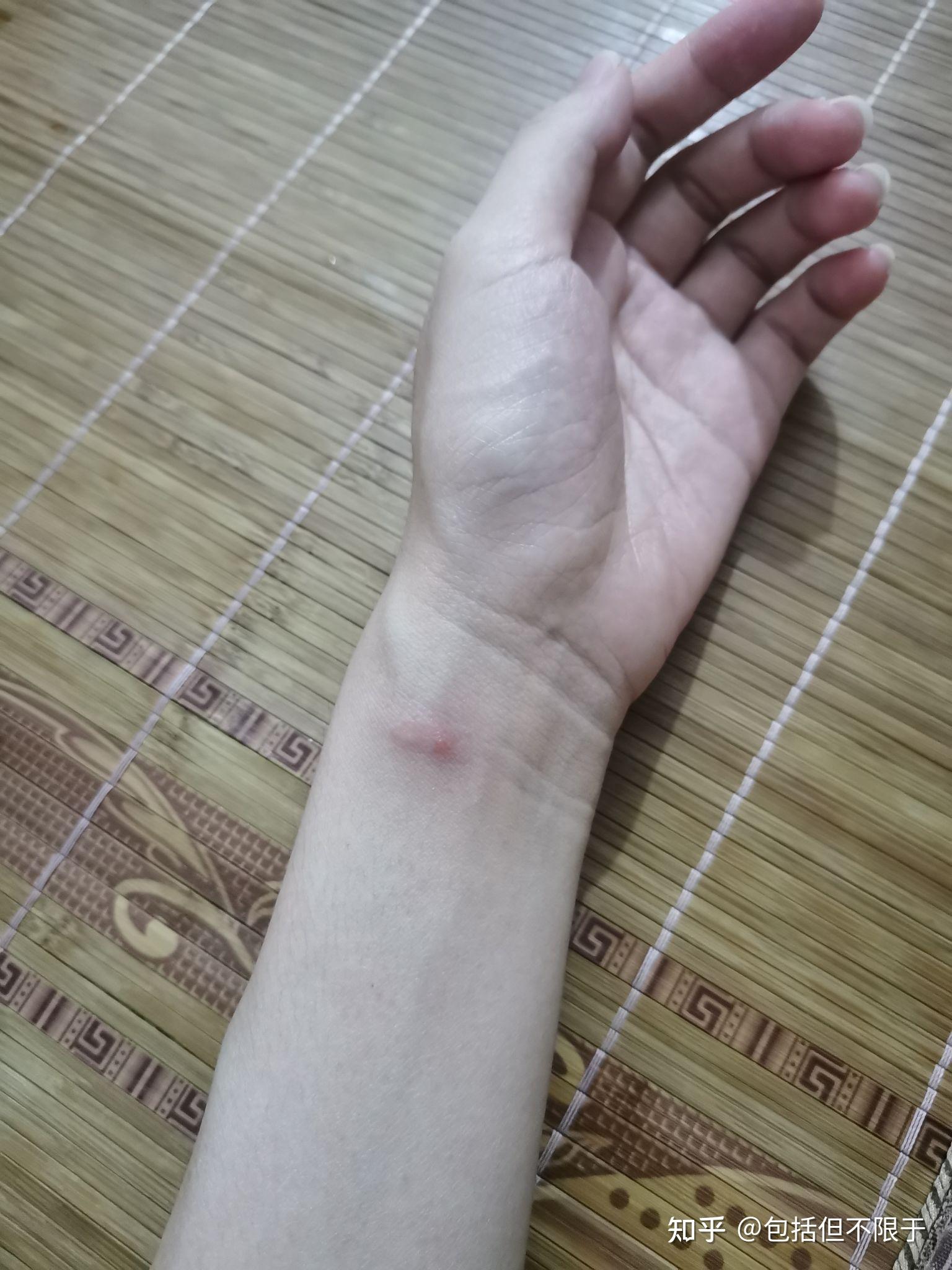 被红蚂蚁咬伤有什么症状?