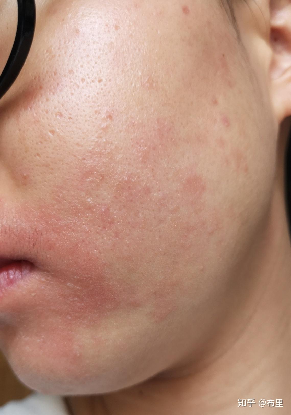 口周炎唇炎怎么才能治得好啊