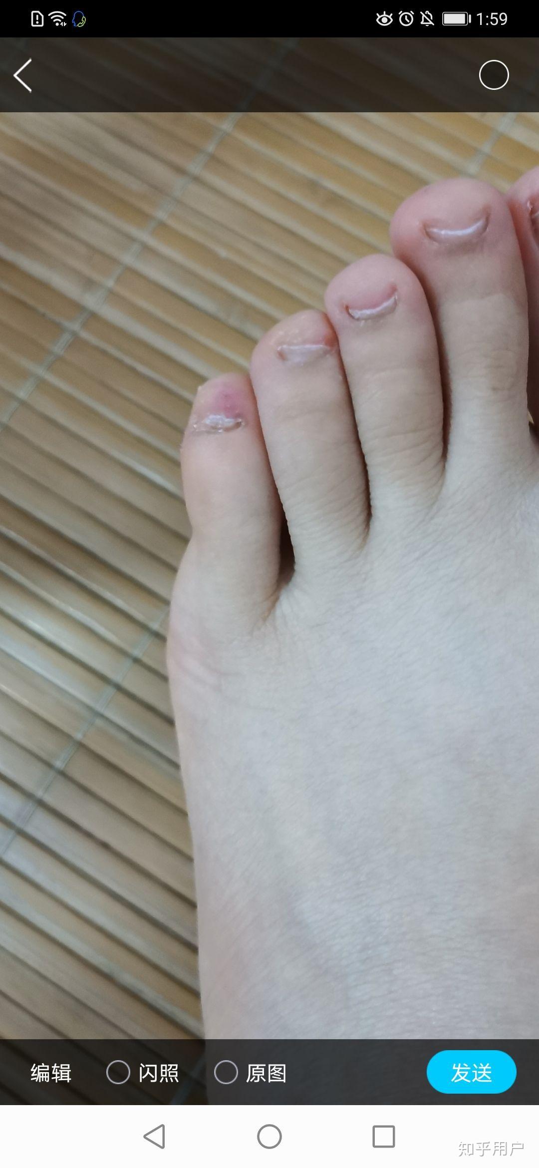 小脚趾的指甲特别难看怎么办