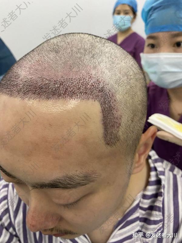 做发际线植发,应该注意哪些才能避坑?