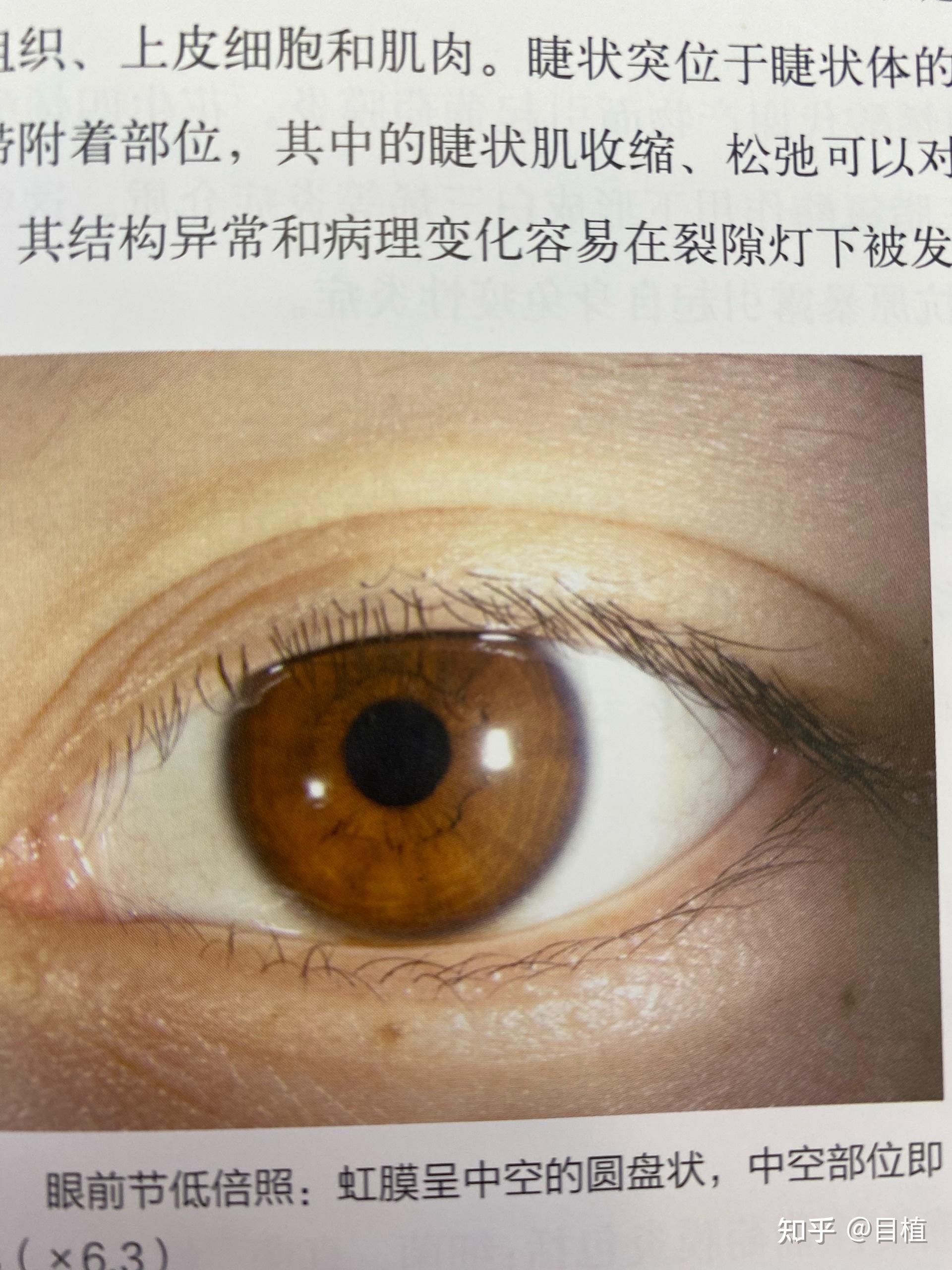 大家眼睛里都有这样的白线吗? - 知乎