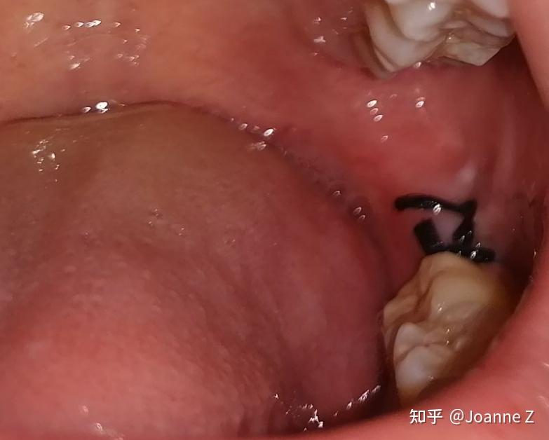 拔完智齿后那一周你经历了什么