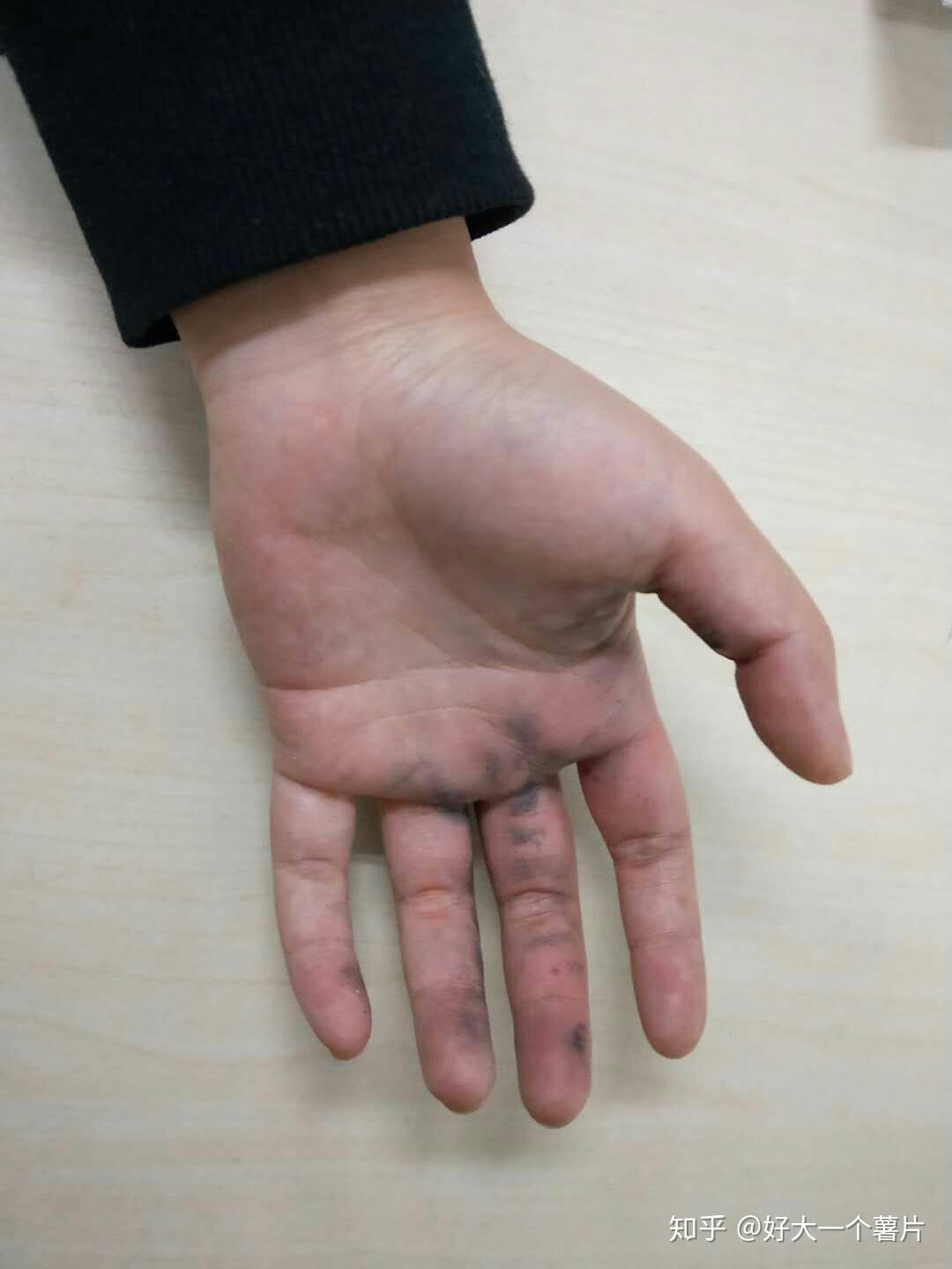 手被鞭炮炸到是什么体验