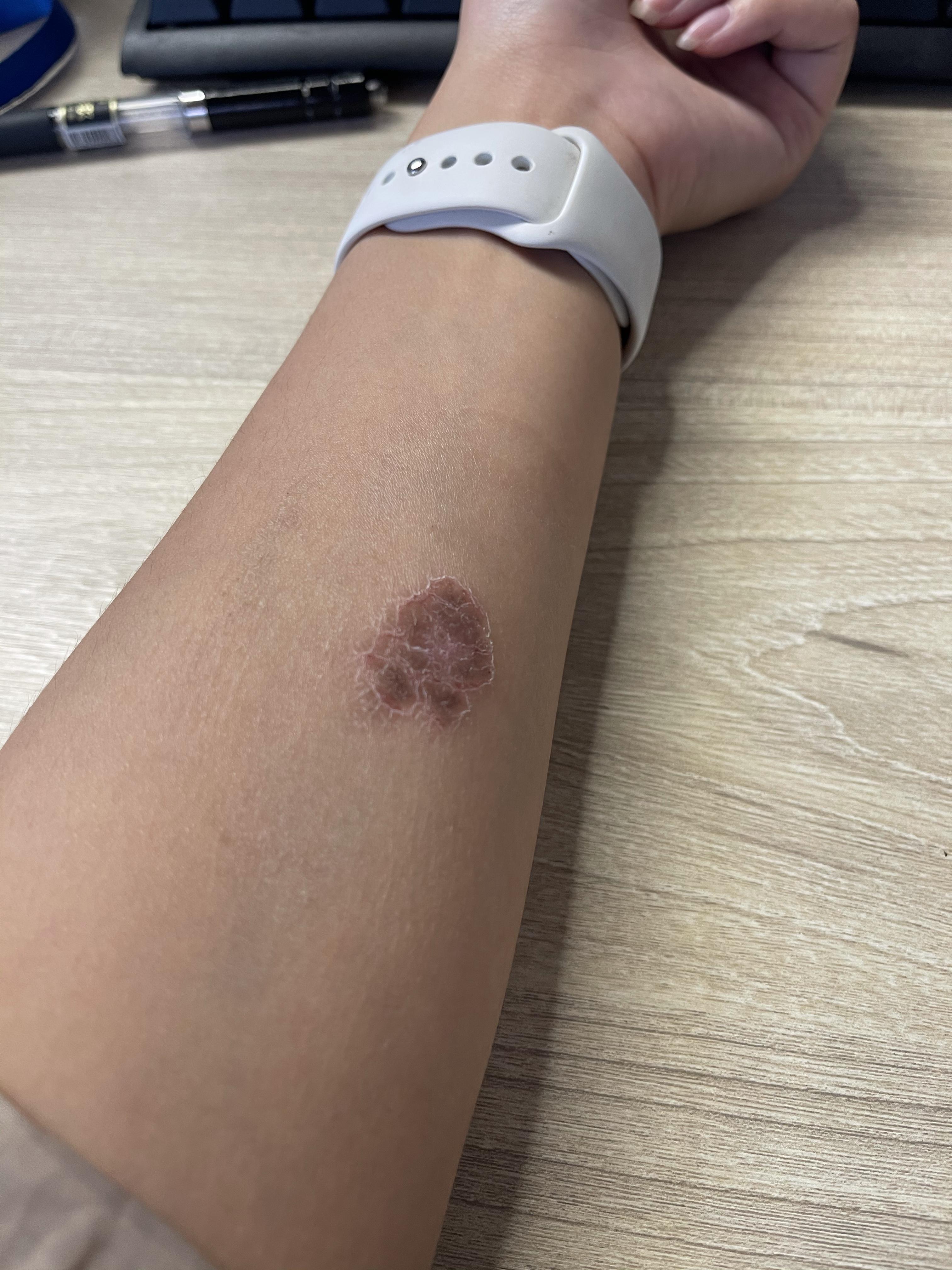 结核皮试起了个大水泡破了怎么办