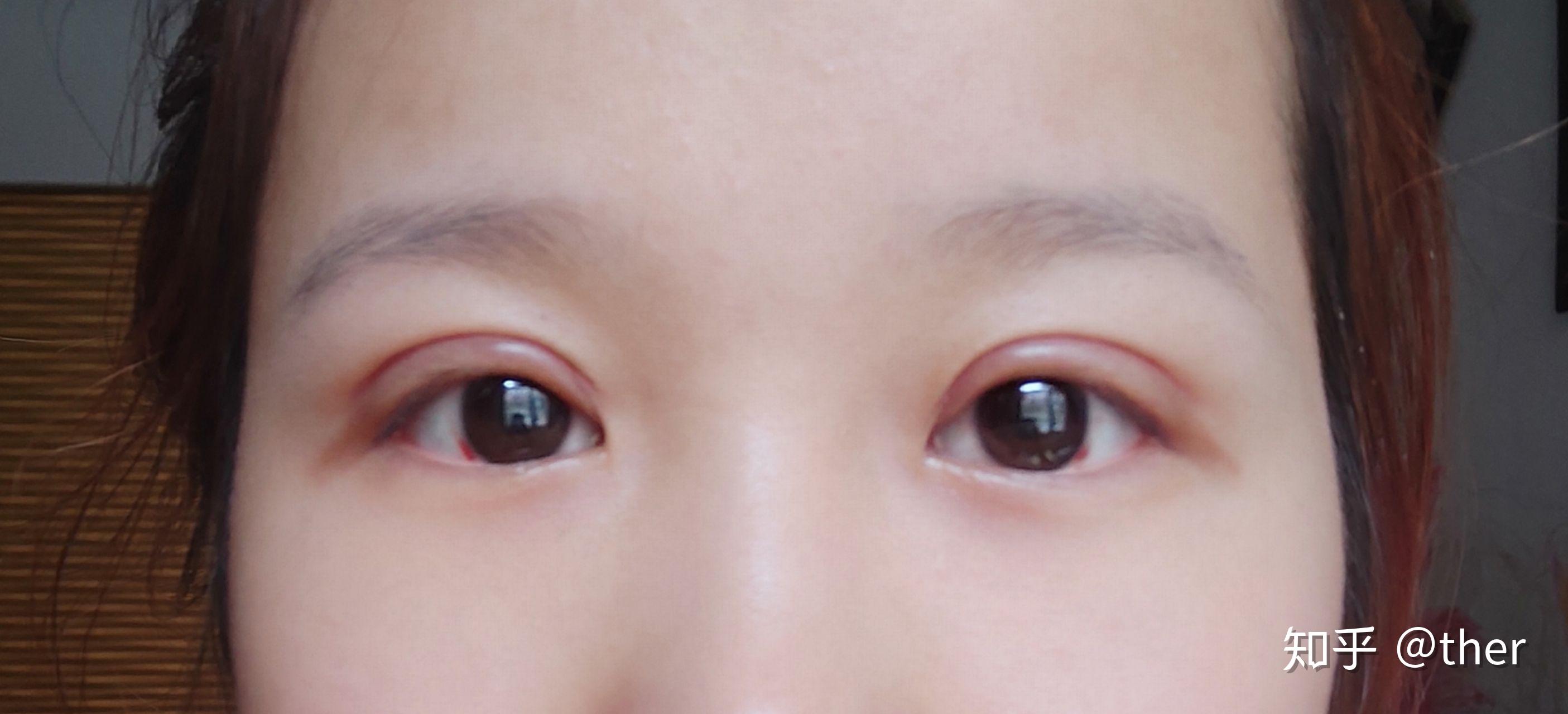 我双眼皮做了一个多月增生期比较严重请问什么时候会消失呢