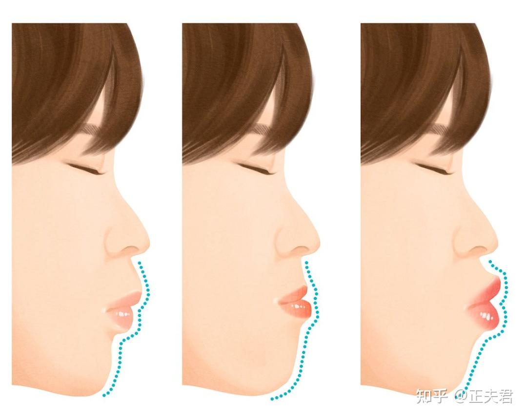 牙齿矫正真的能改变脸型吗