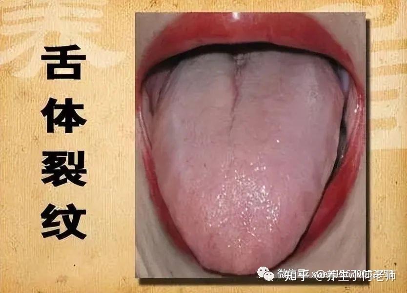 裂纹舌,多半是肝脾不好,一张方子:清肝热,滋胃阴,快收藏 - 知乎