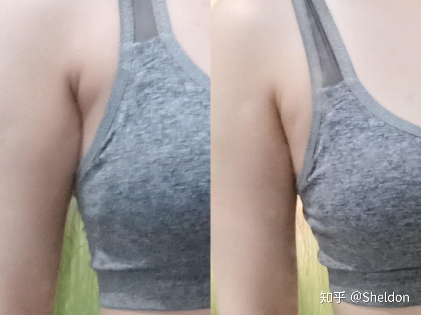 副乳两旁图片