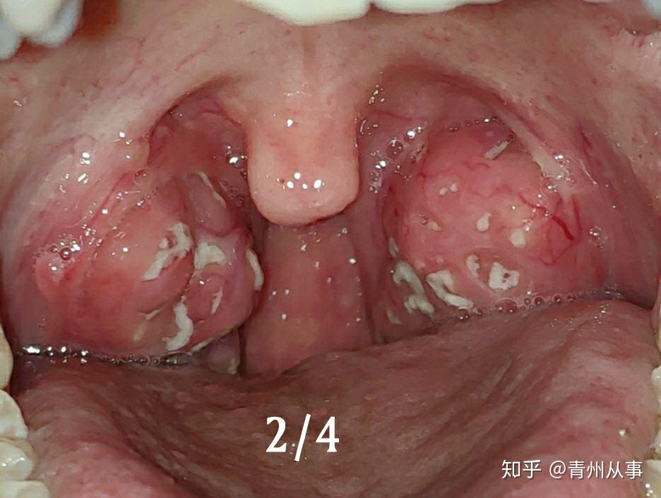 化膿性扁桃體炎多久能好