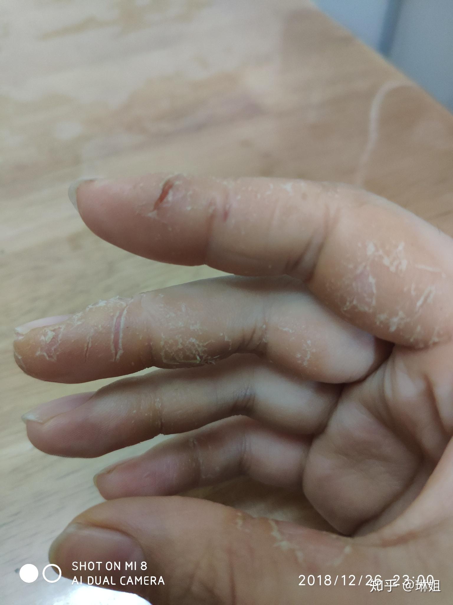 手上干裂型湿疹在哪里看比较好? - 知乎