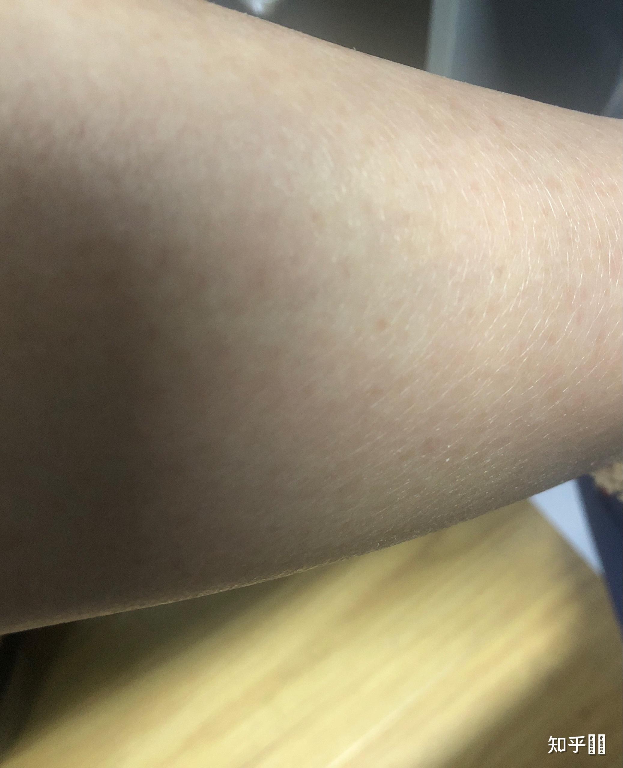 小腿皮肤很干燥,像鱼鳞一样怎么消除? - 知乎