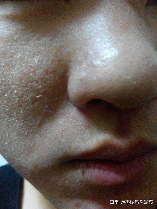 这是普通的面部起皮吗? - 知乎