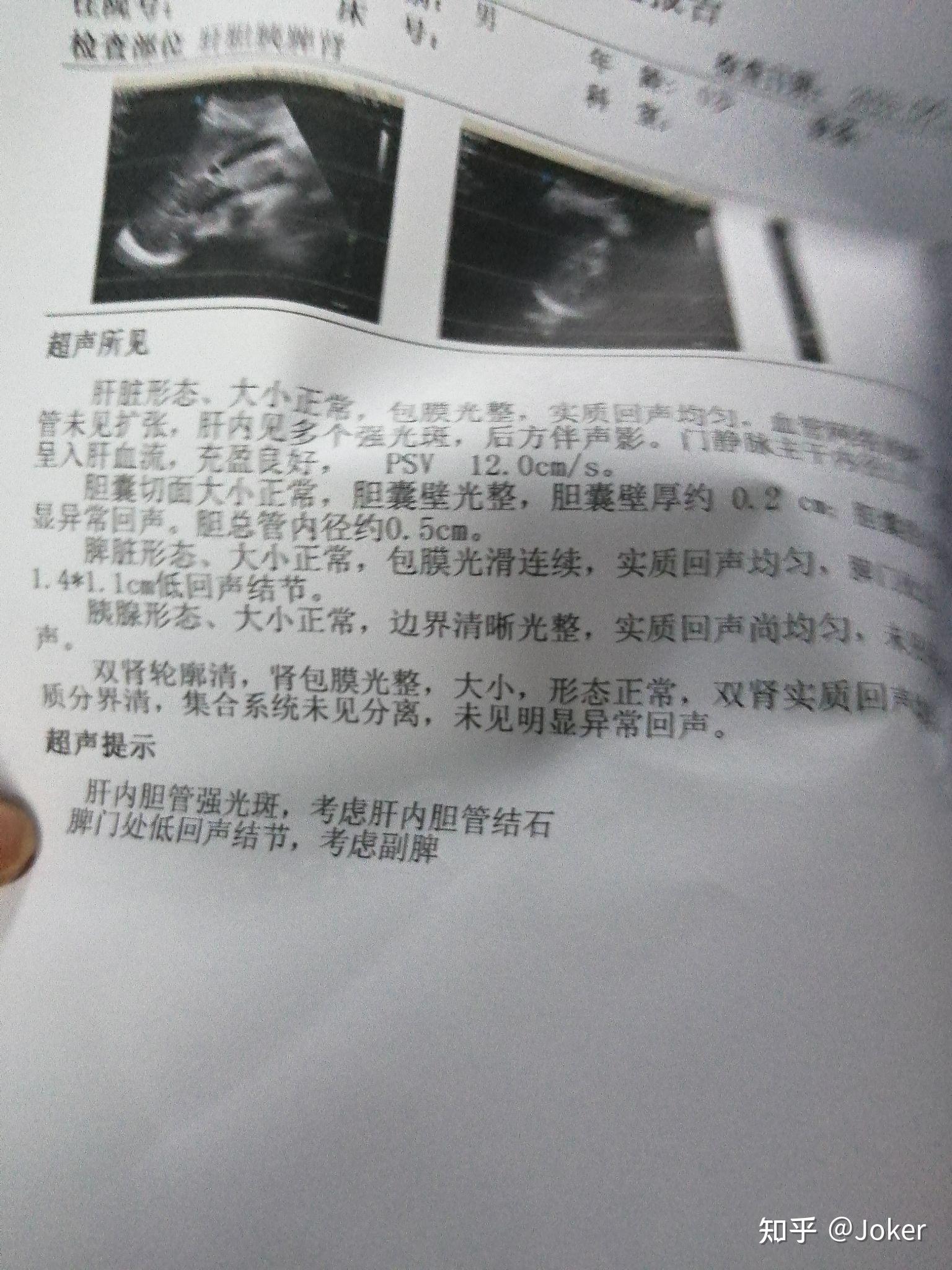 肝内胆管结石4x3mm怎么治疗效果最好希望能有更好的解决方案谢谢了