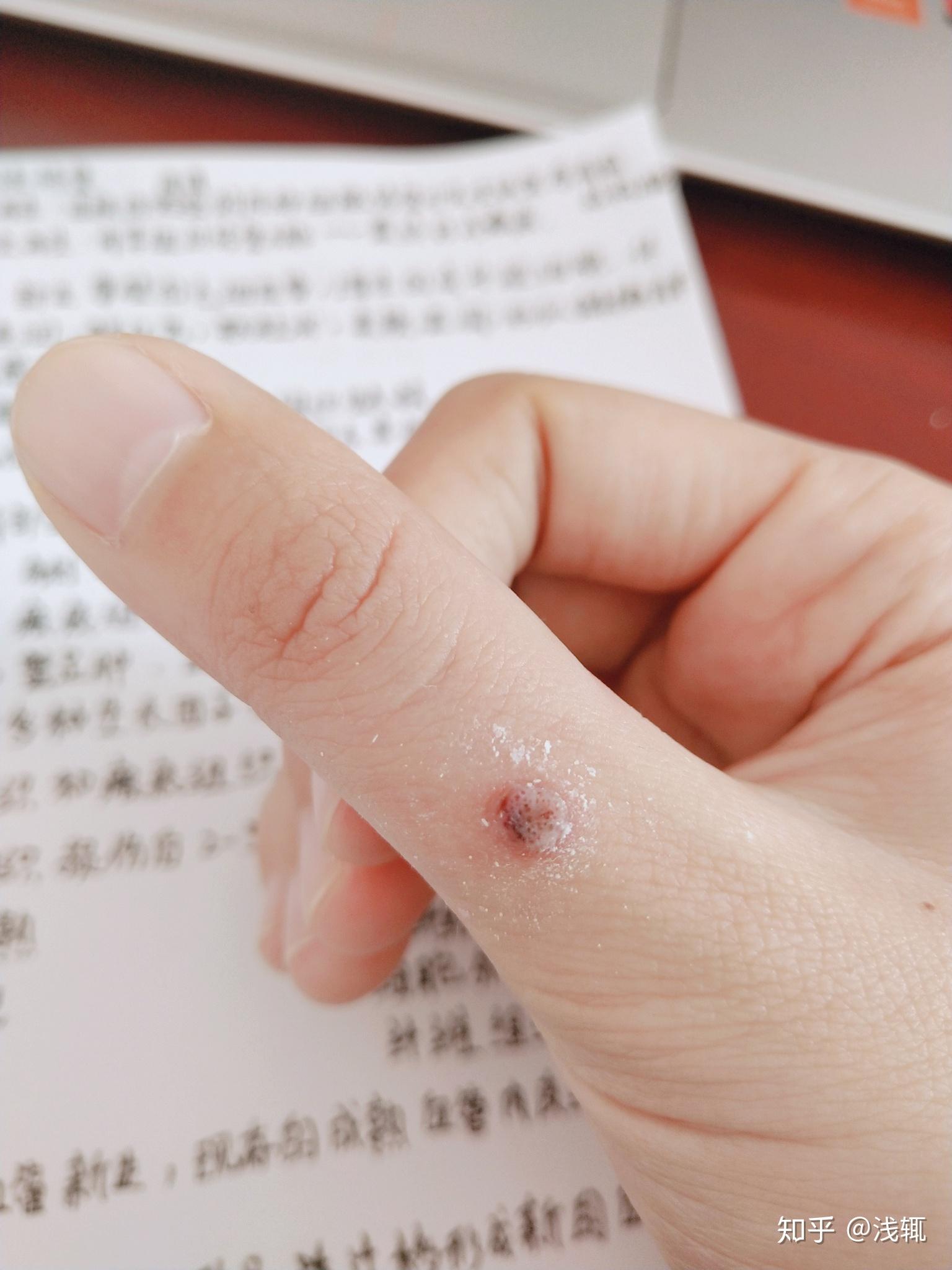 手上长了瘊子该怎么治疗?求帮助. - 知乎