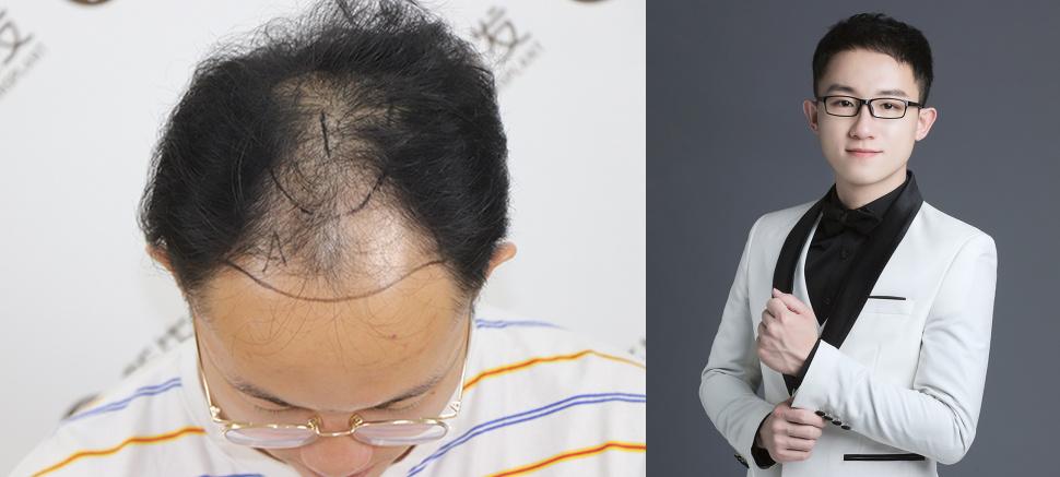 马斯克(elon musk) 的植发效果为何如此好? - 知乎