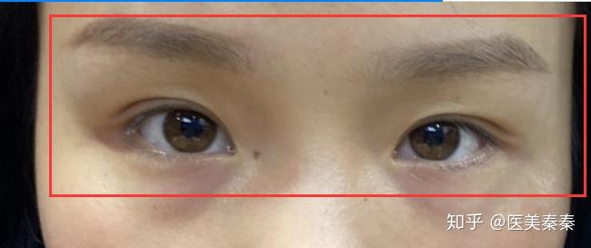 为什么会大小眼啊 高低眉 不对称? - 知乎