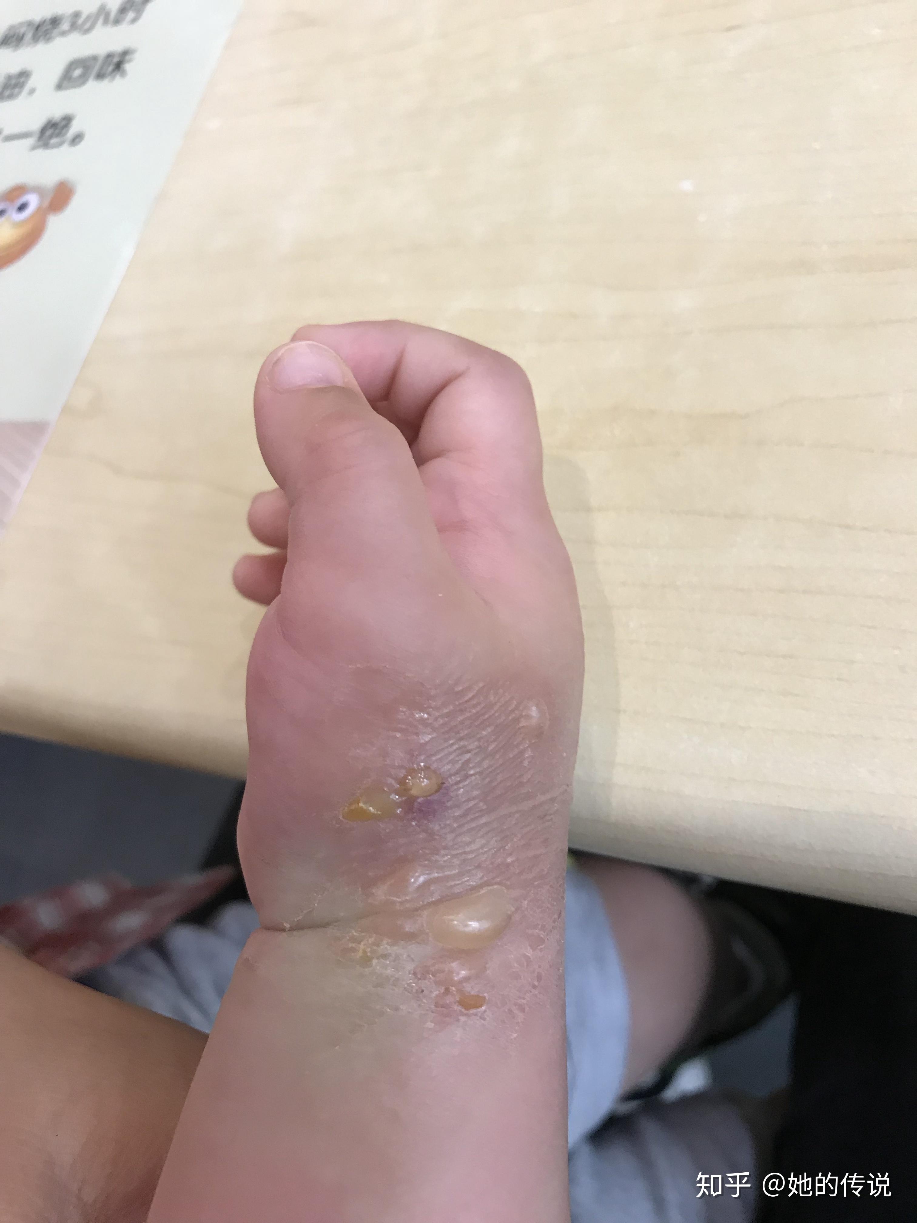 被隐翅虫咬了怎么治?让他自己好?还是要看医生? - 知乎