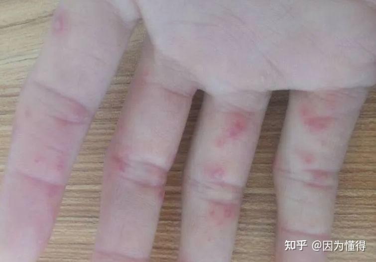 冻疮很痒怎么办? - 知乎