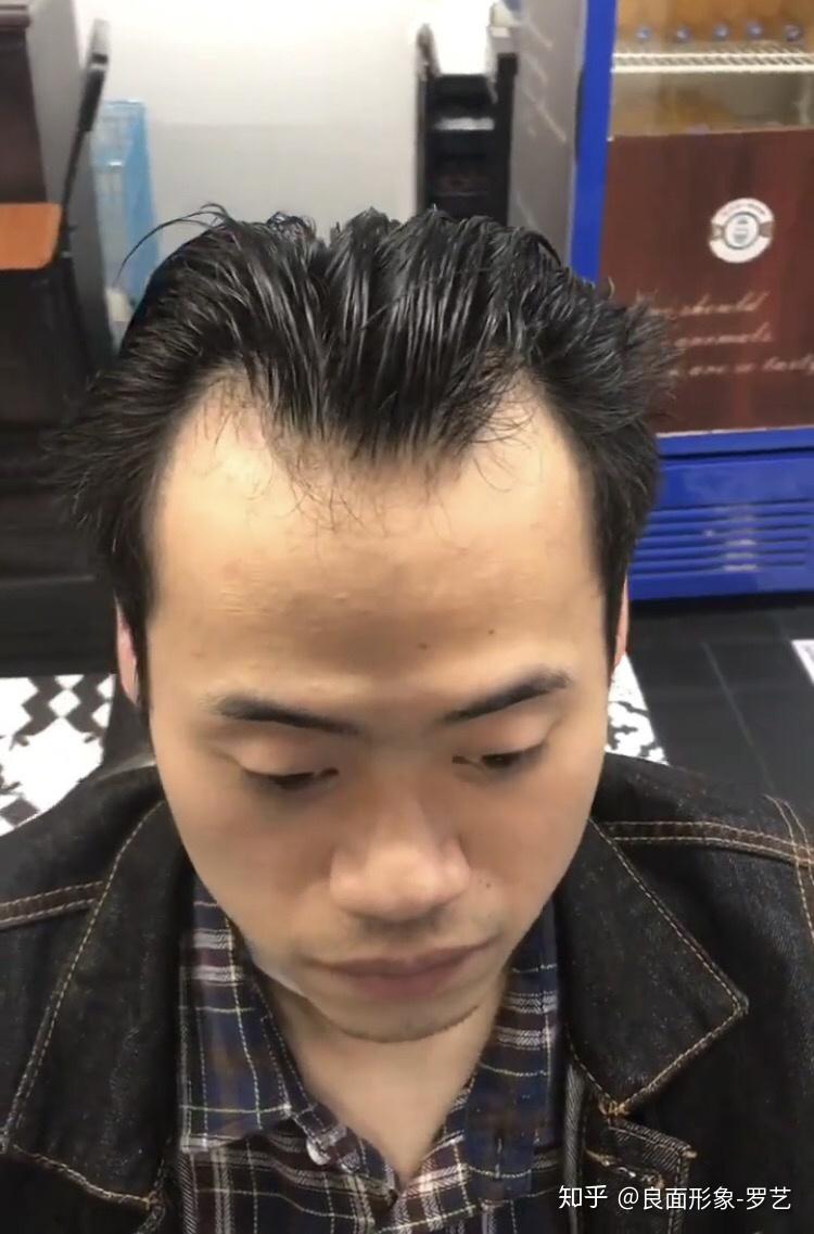 秃额角发际线高适合什么发型