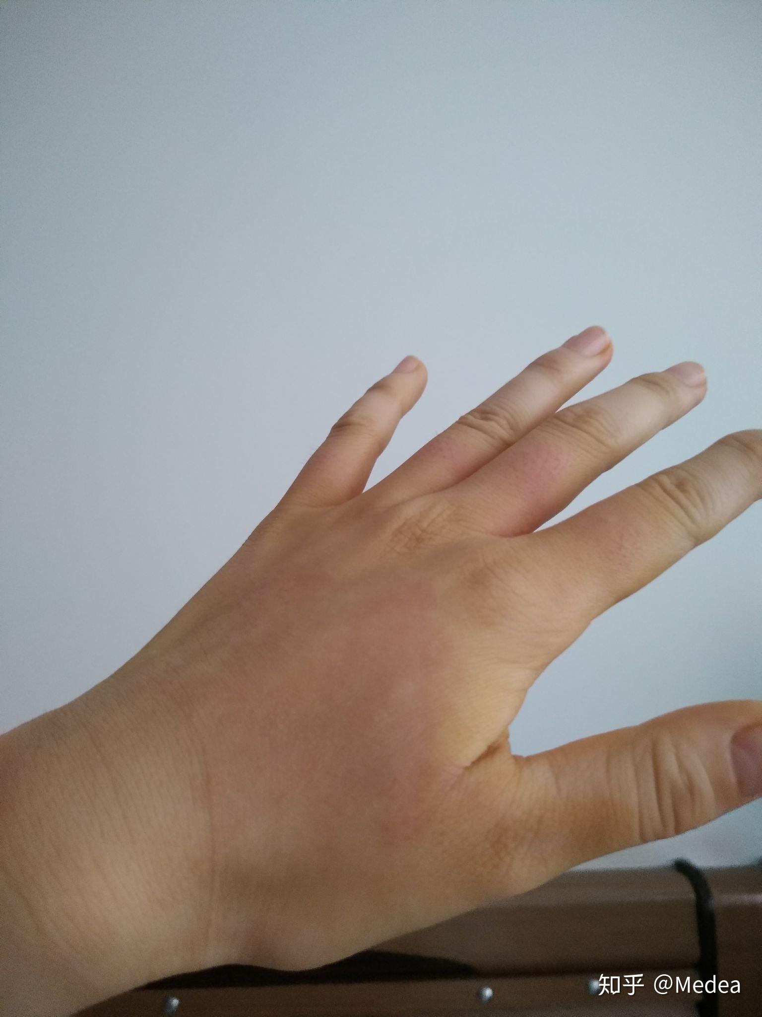 手被开水烫伤了怎么办