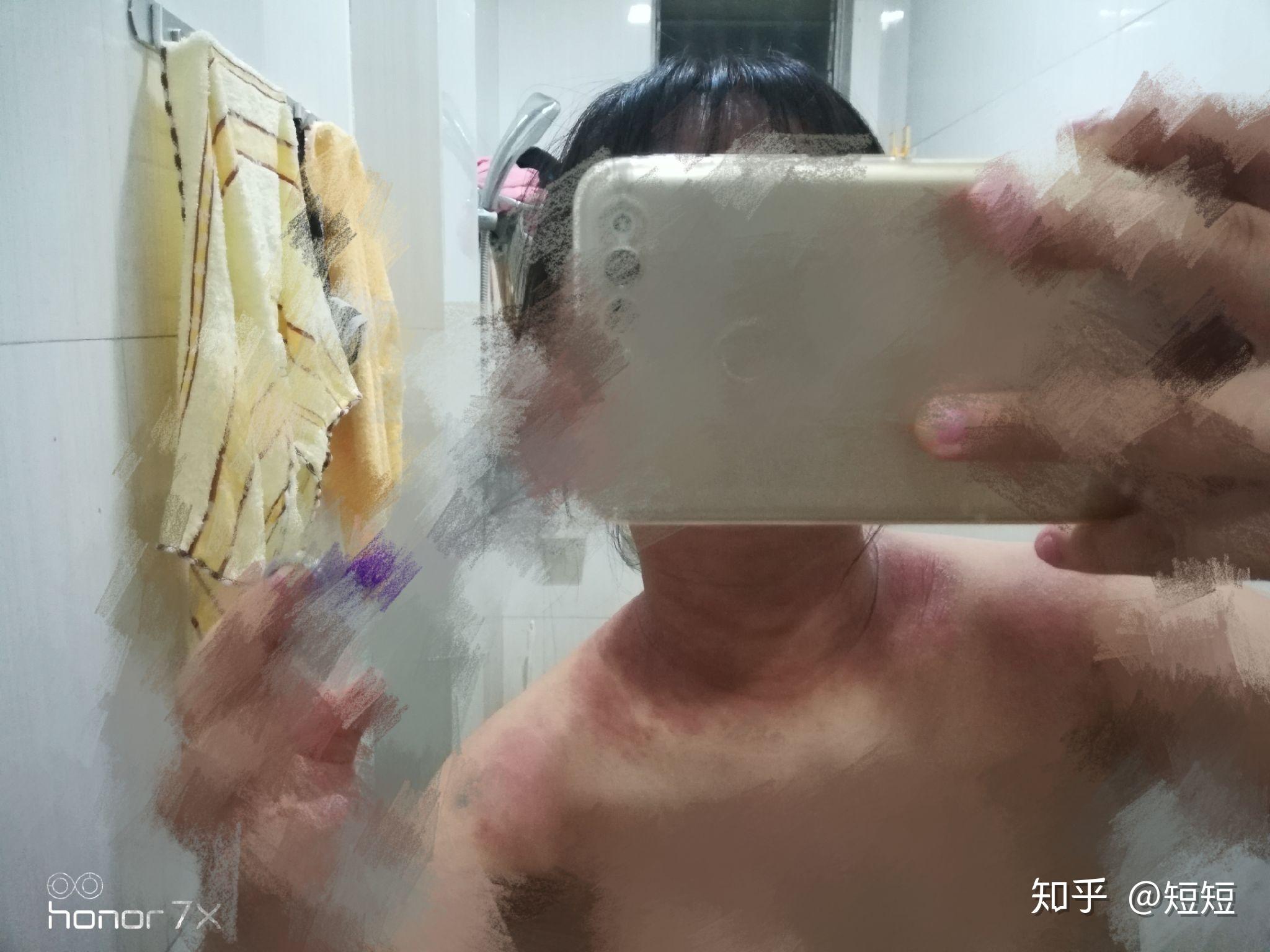 对自己的汗液过敏是什么体验?