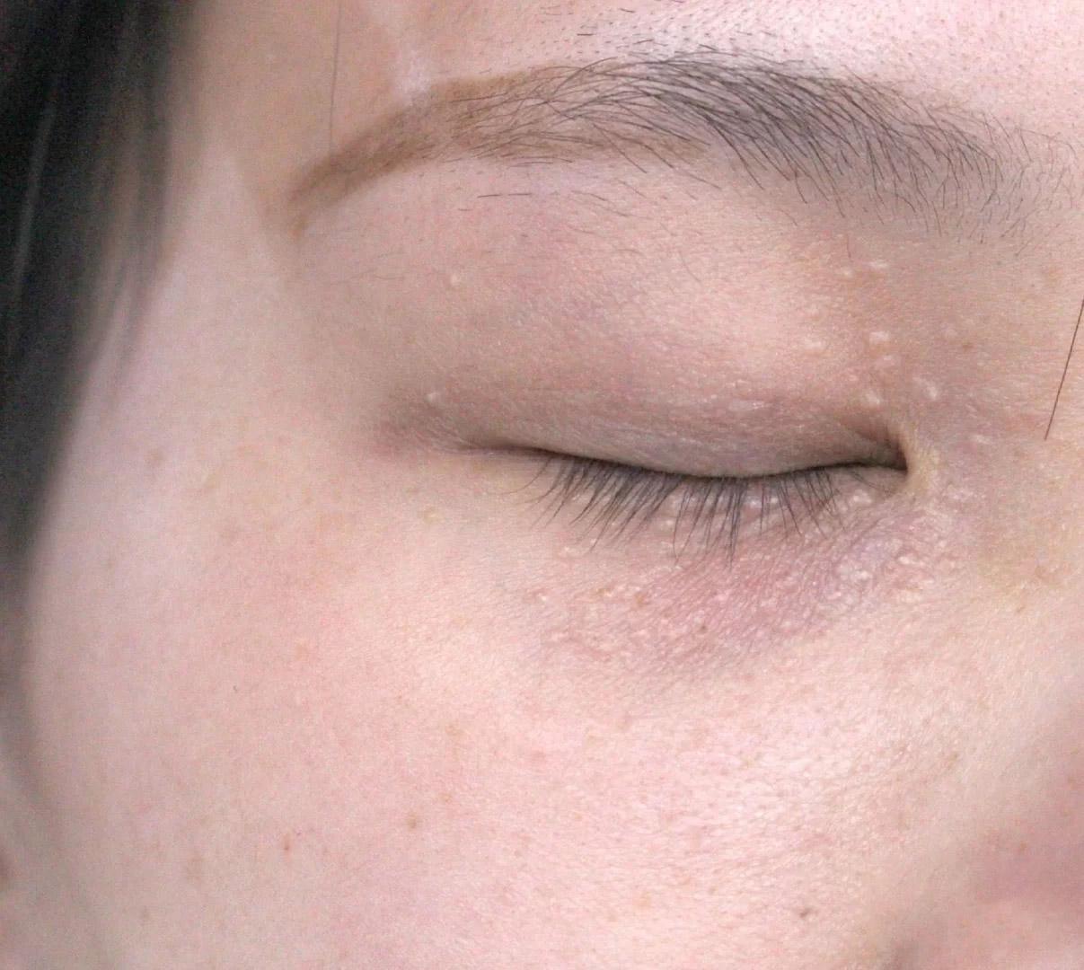 请问你们有谁长了脂肪粒好了的吗? - 知乎