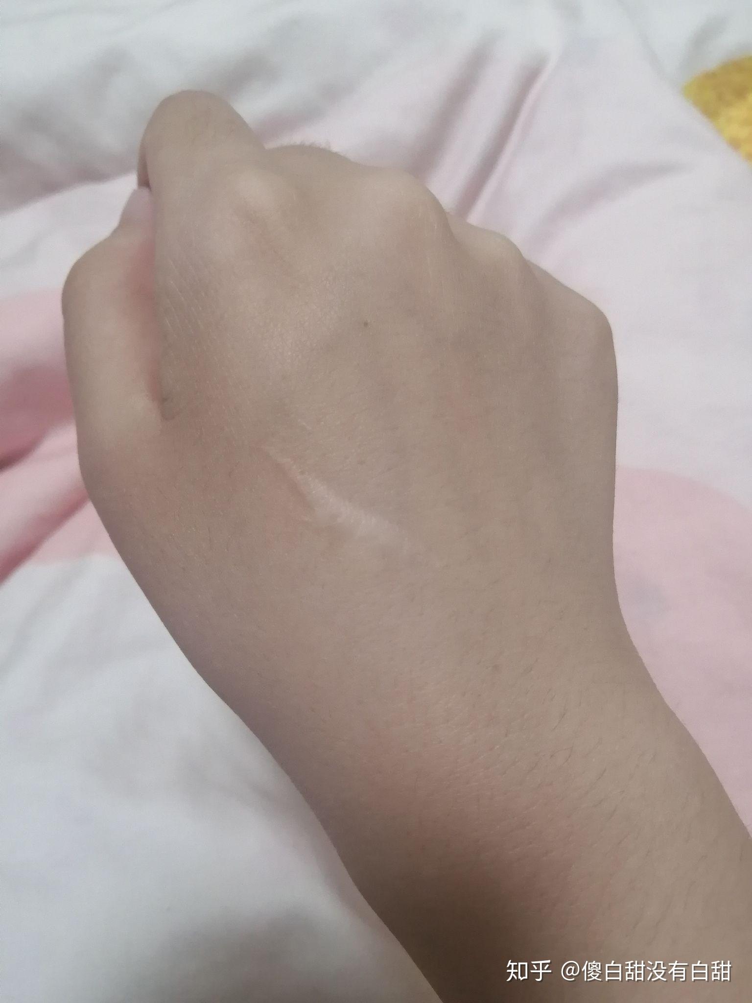 怎样去掉手上的疤? - 知乎