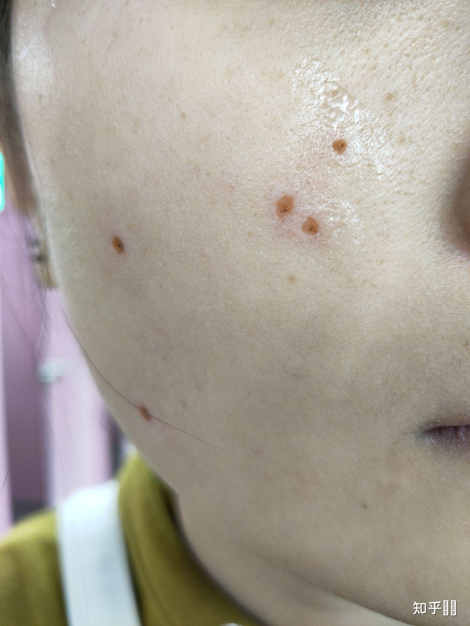 刚刚激光点痣为什么周围有黑圈还是黑呼呼的是没点干净吗? - 知乎