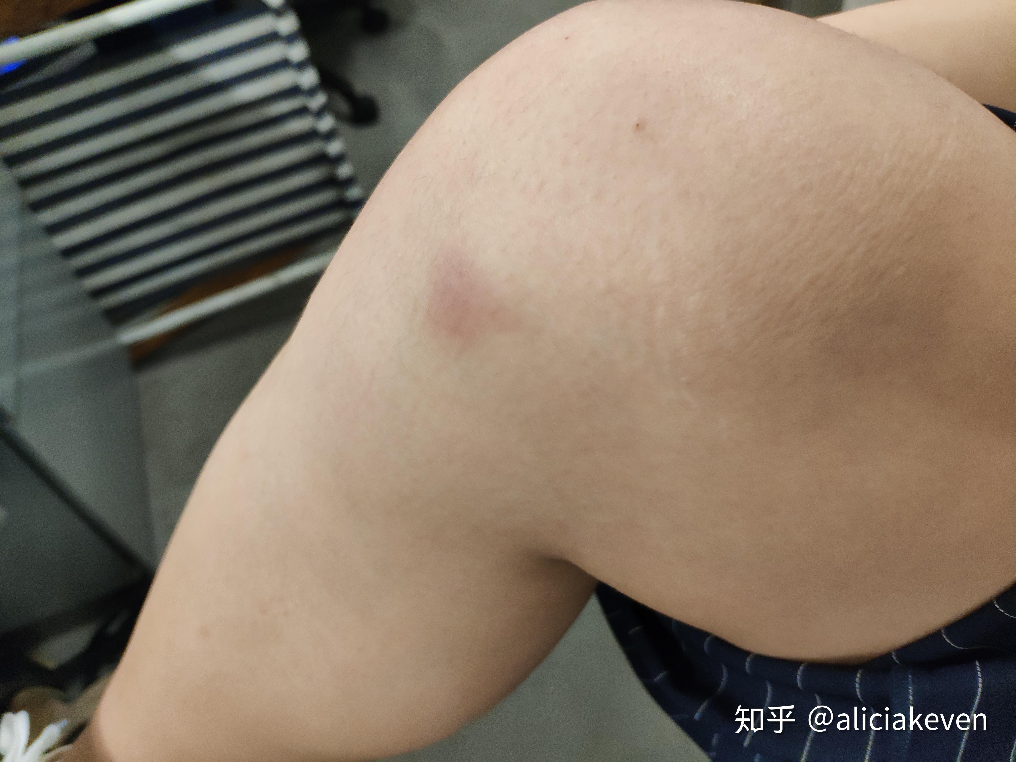 做完深蹲膝盖出现淤青是怎么回事