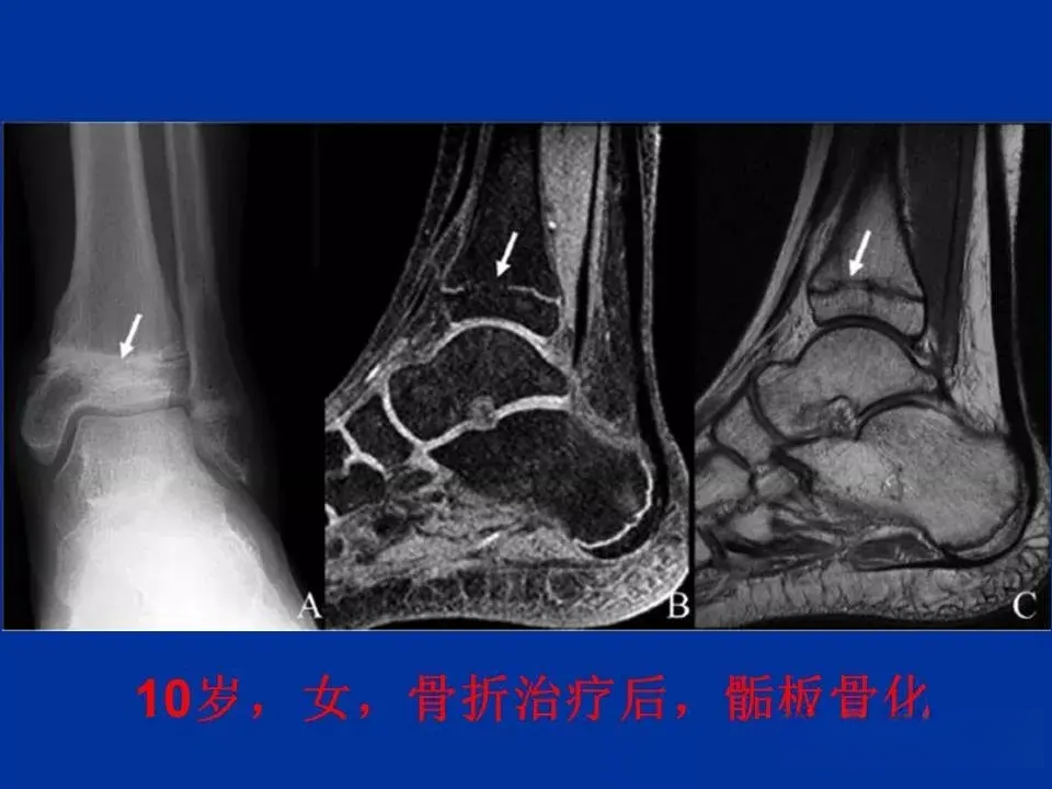 骨骺软骨损伤MR高清影像诊断图文详解 - 知乎