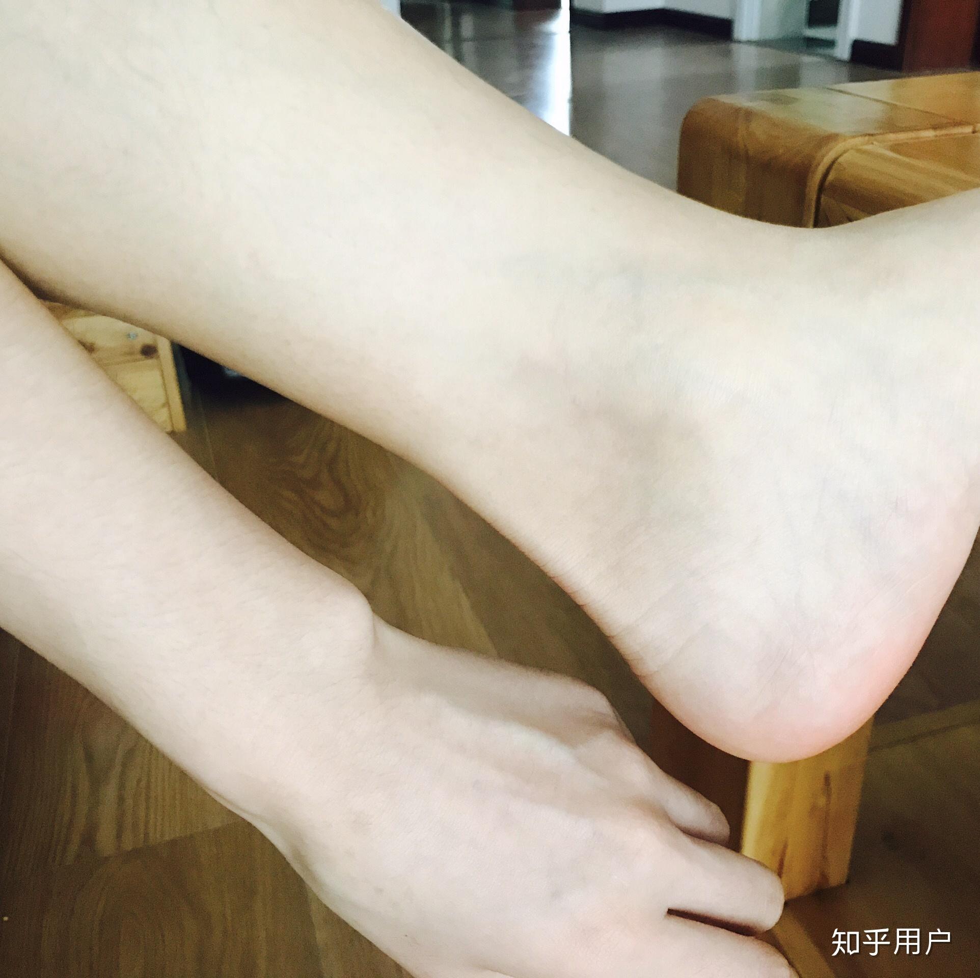 女生脚踝粗是基因决定的吗