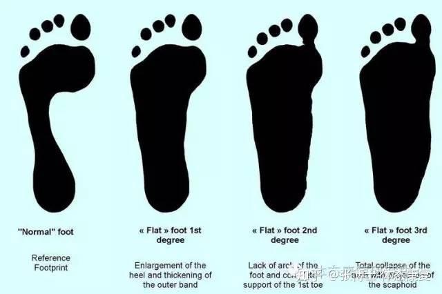 扁平足该如何进行运动矫正呢? - 知乎