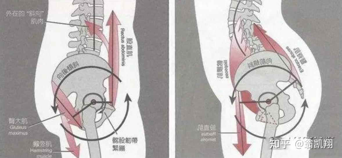 怎么矫正骨盆后倾