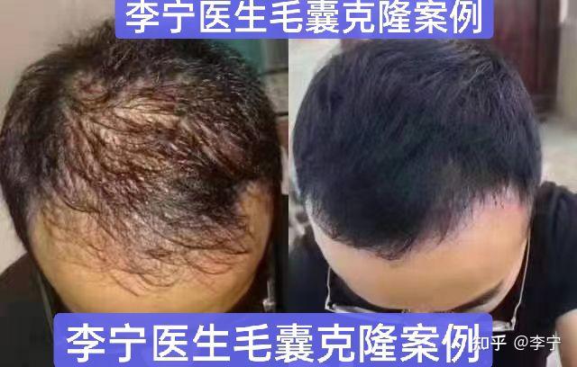 真正的毛囊克隆技术还要多久才能问世