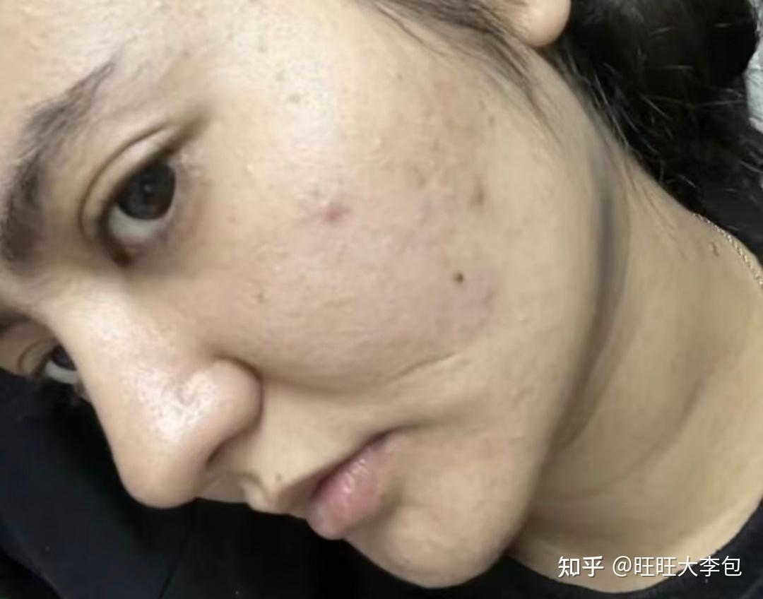 用针把痘痘弄破,会好吗? - 知乎