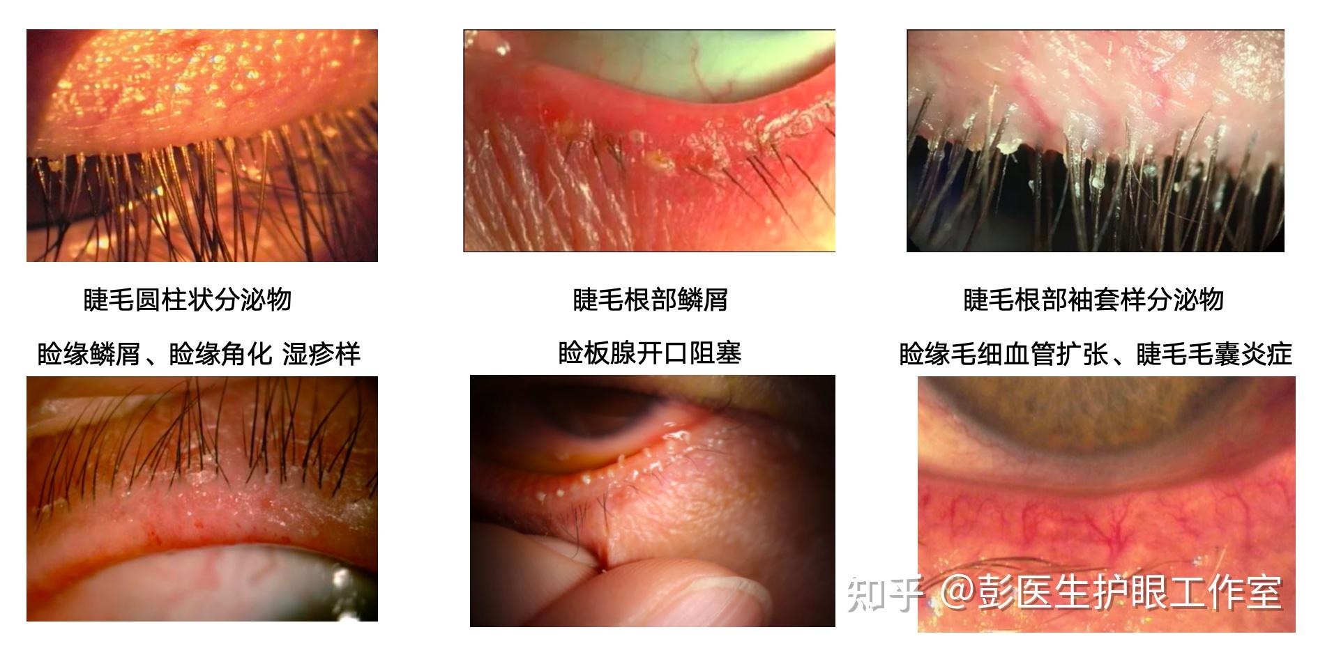 睑缘角化图片