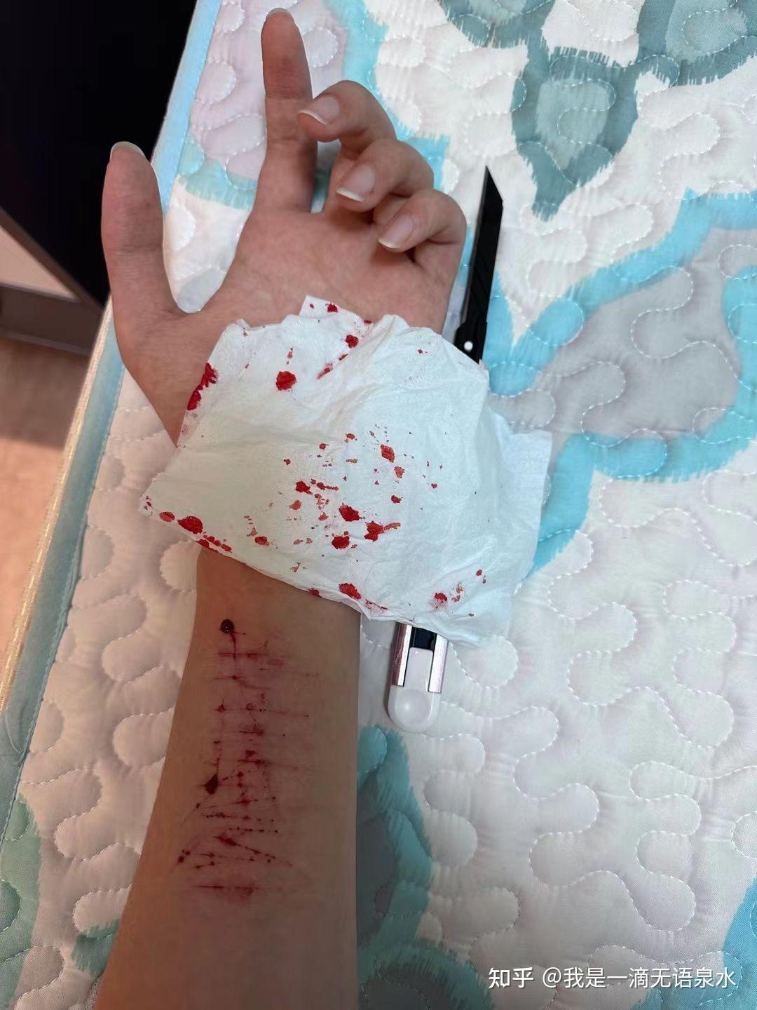 手腕上有自残的粑,需要除,但又不敢跟家长说怎么办? - 知乎