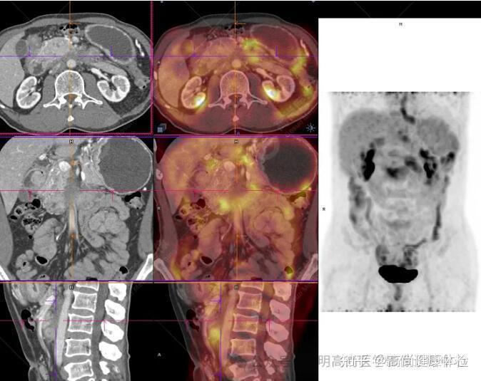 63岁男性,胃印戒细胞癌一例 - 知乎