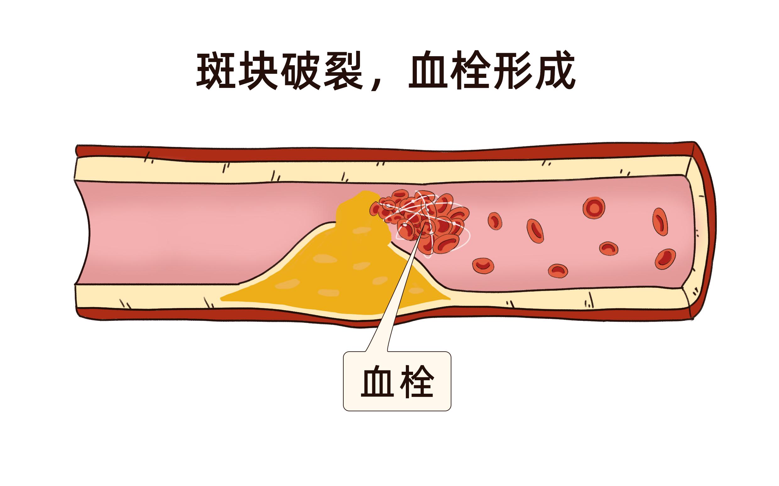 正确认识血管斑块