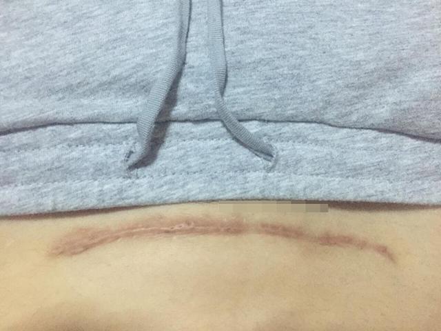 剖腹产选择“横切”还是“竖切”？别轻视这一刀，两者效果大不同 - 知乎