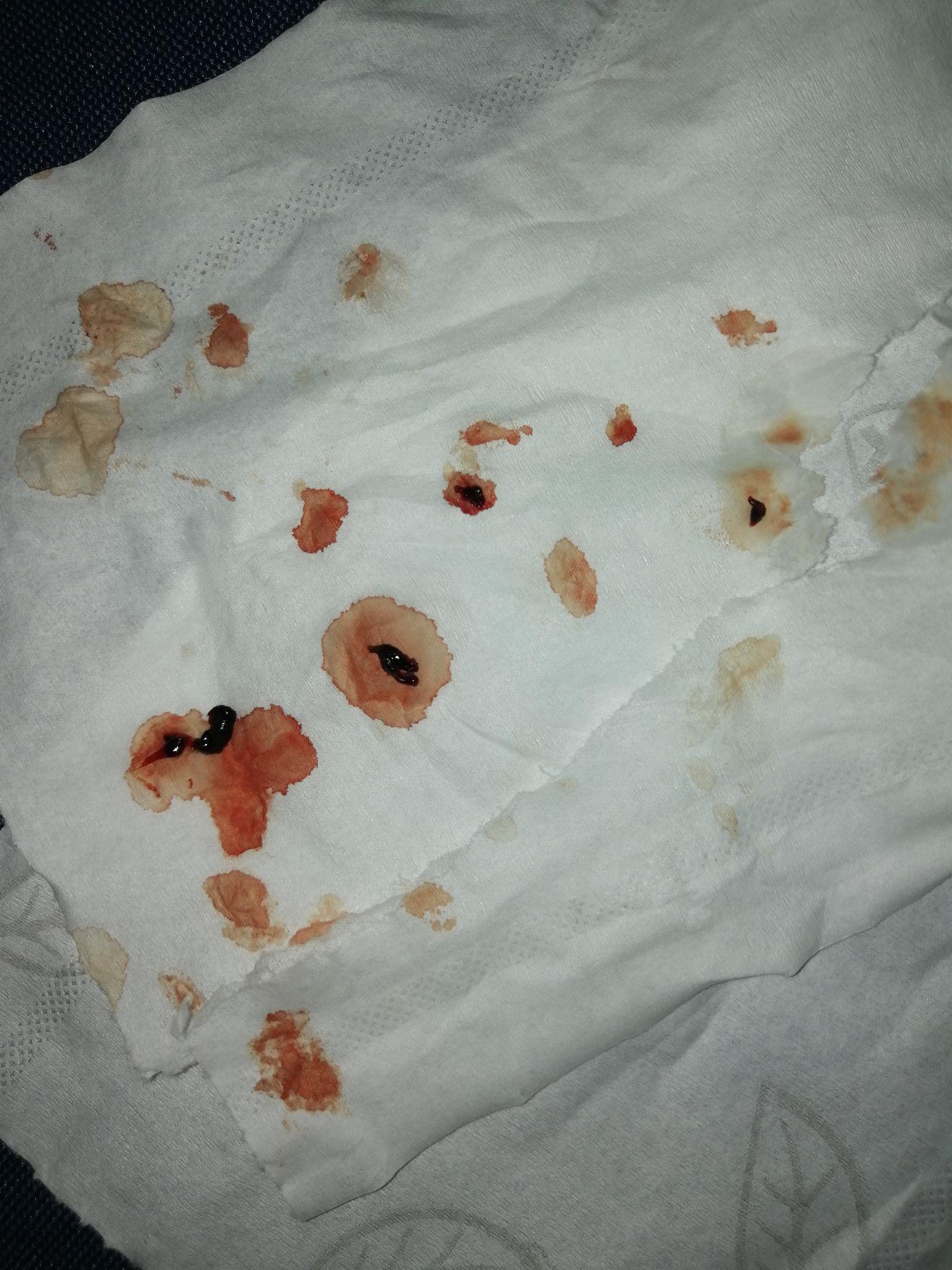 拔牙后血凝块长什么样子? - 知乎