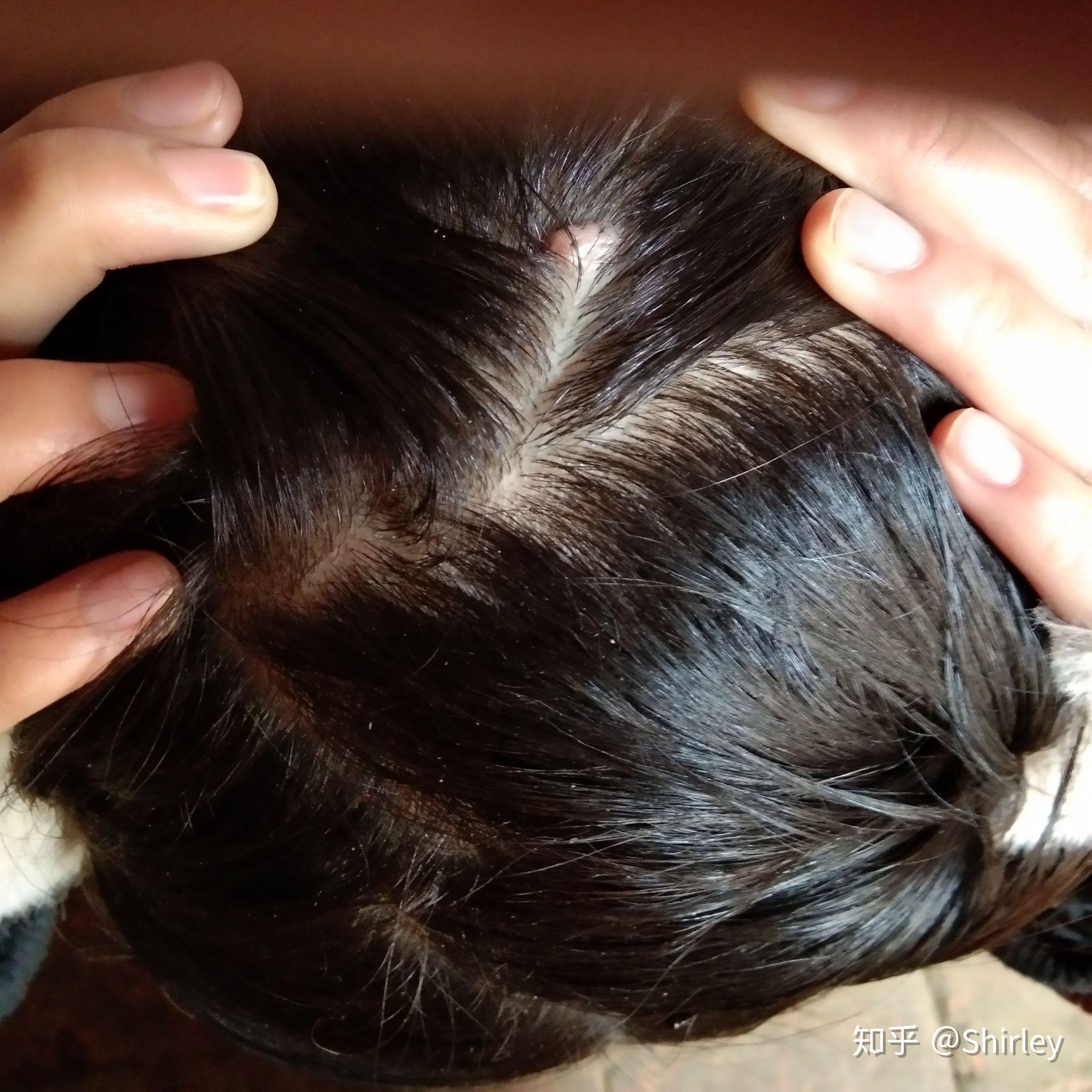 后脑勺长了一个肉疙瘩? - 知乎