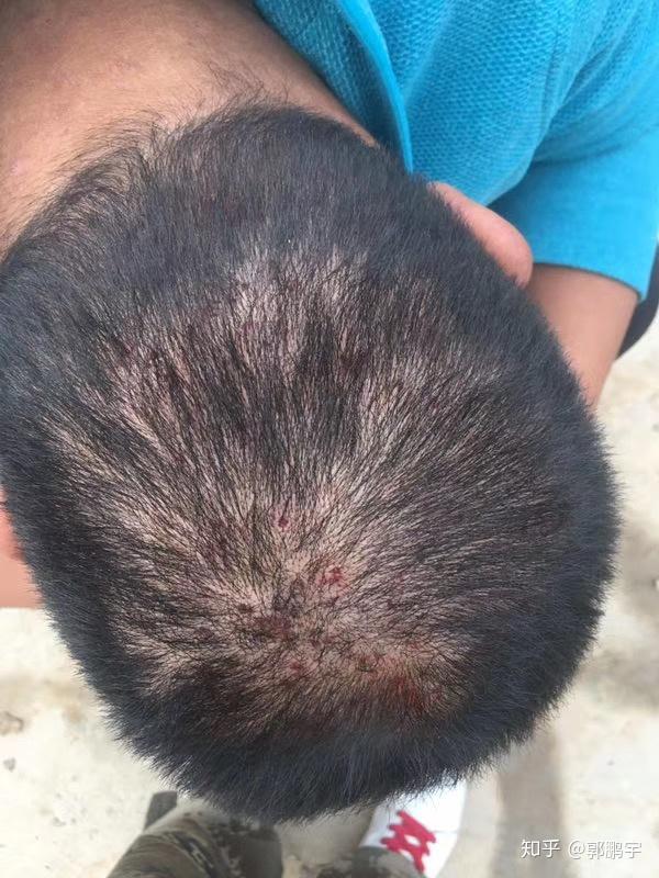 脱发性毛囊炎怎么才能好