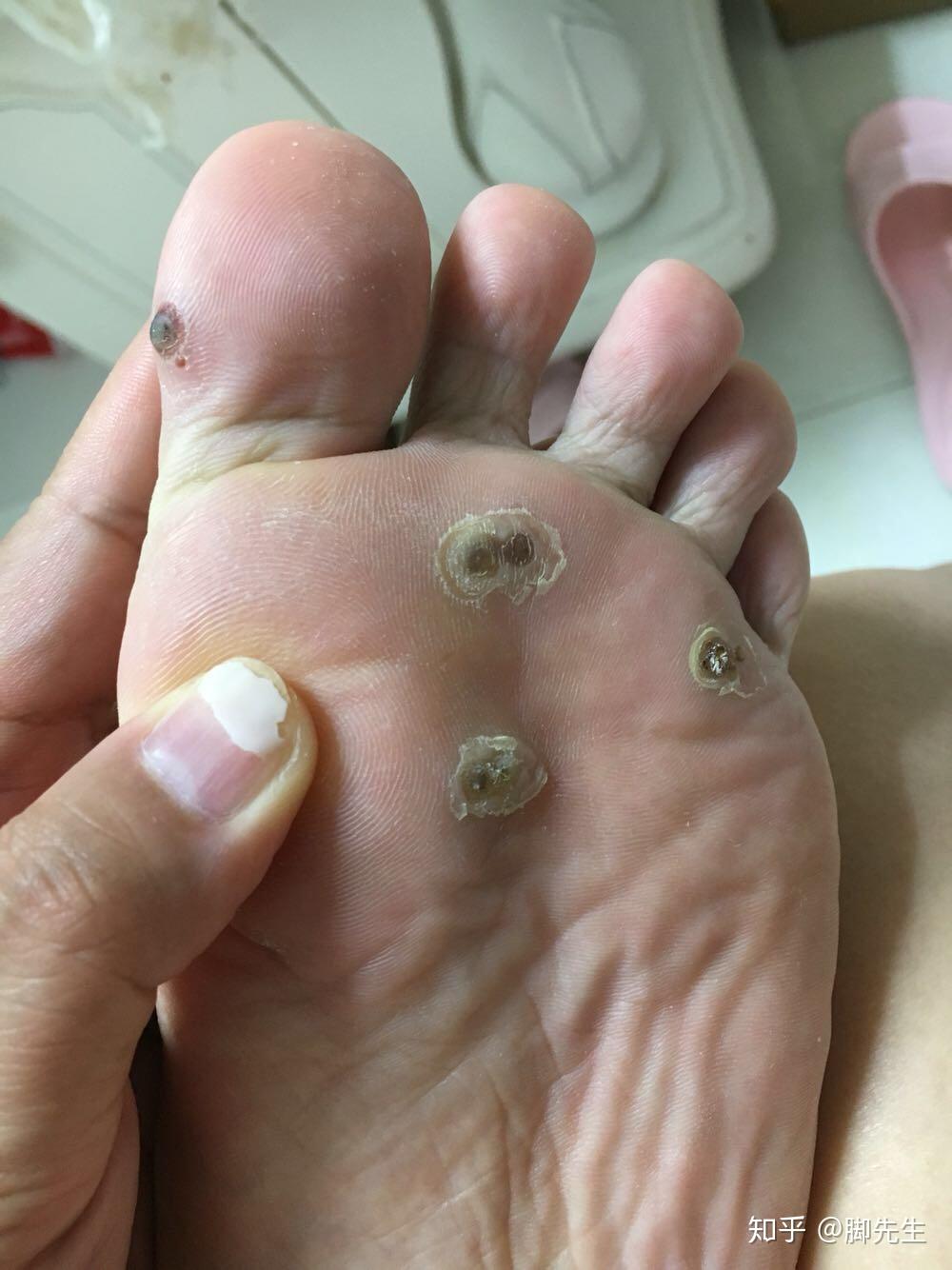 刚长出来的小跖疣怎么治