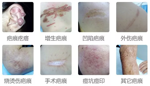 外伤性疤痕的认知 - 知乎